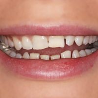 Composite Bonding - Smile 18 before